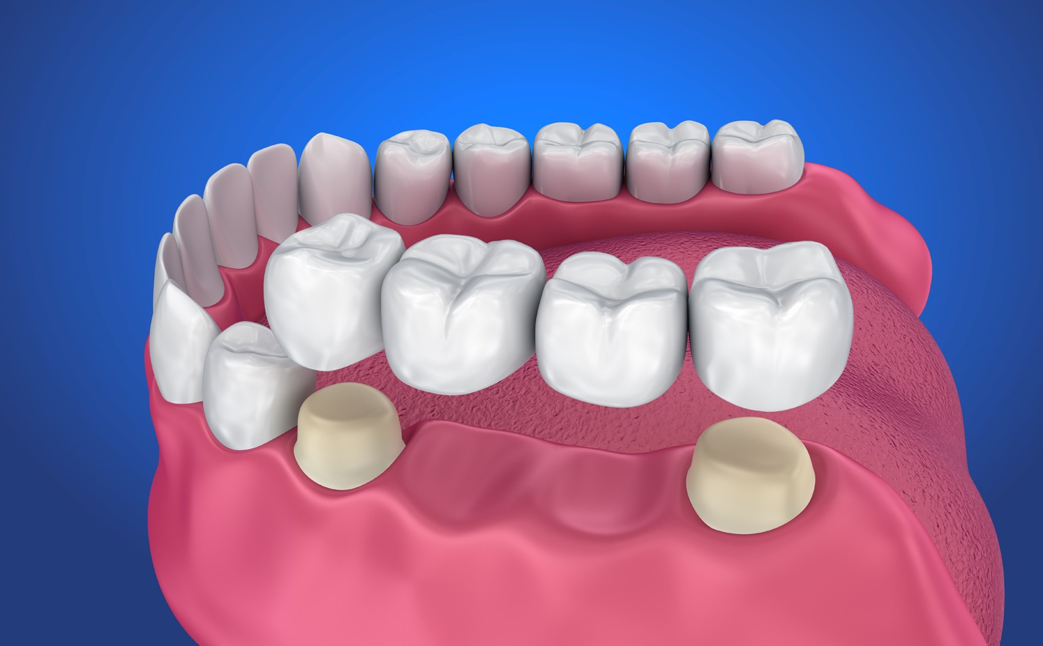 Porcelain Fixed Bridges Welcome Dental Centre